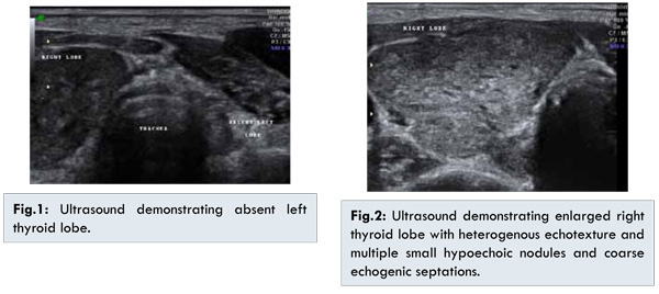 Isthmus Thyroid Ultrasound